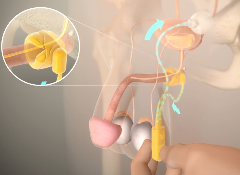 Artificial Spincter Animated Illustration