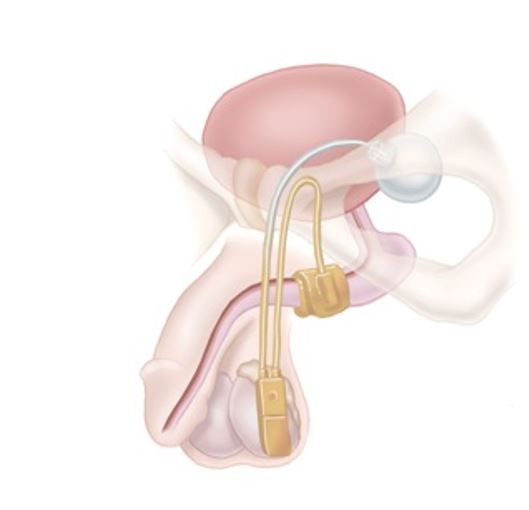 A 3 part urinary control system