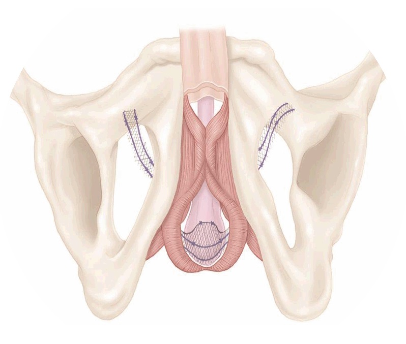 An advanced male sling - Incontinence solutions