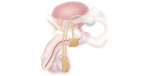 Artificial Urinary Sphincter (AUS)