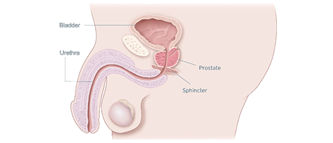 Stress Urinary Incontinence